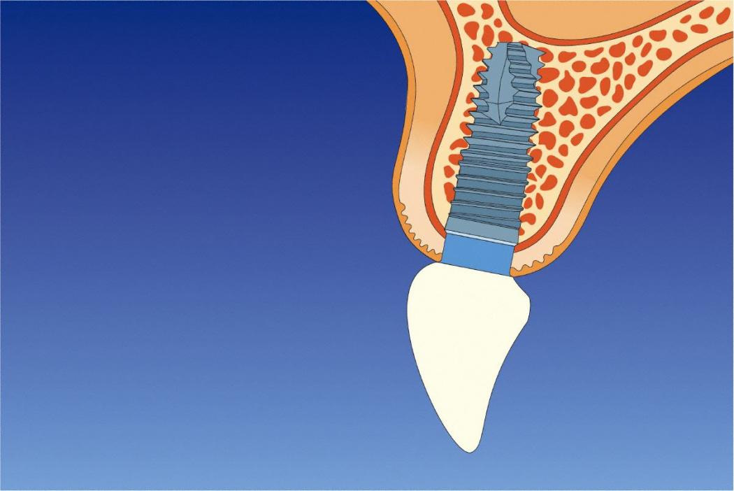 Implantat mit Krone
